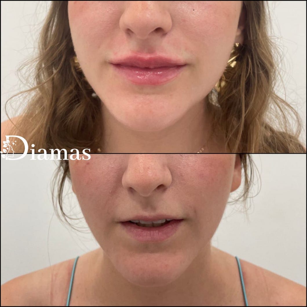 Relleno de labios clínica estética Diamas