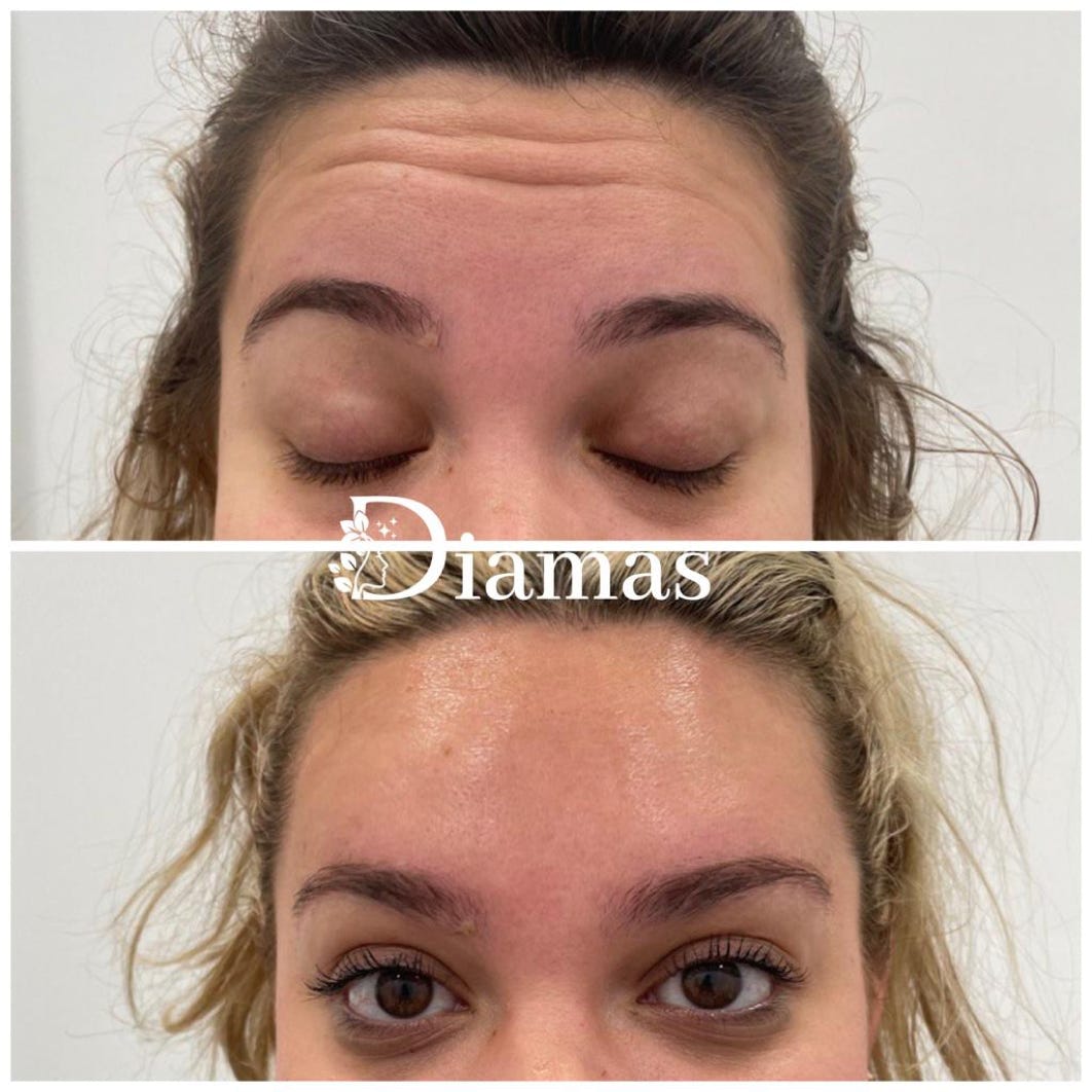 ELIMINACION ARRUGAS EXPRESION MALAGA, BOTOX MALAGA, DOCTORA SMIRNOVA MALAGA, TRATAMIENDO ARRUGAS