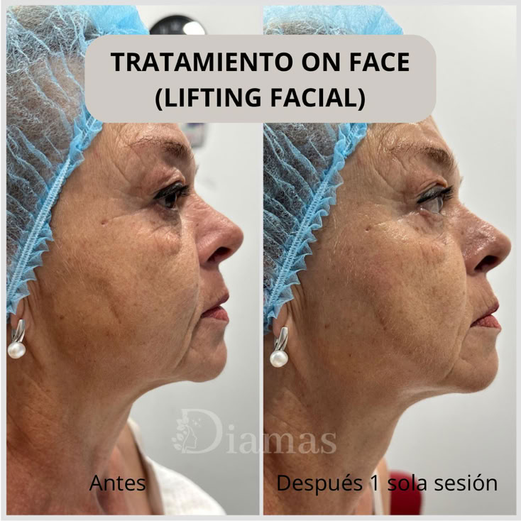 lifting facial diamas, tratamiento on face, eliminaciion de arrugas, tratamiento indoloro, lifting, diamas.
