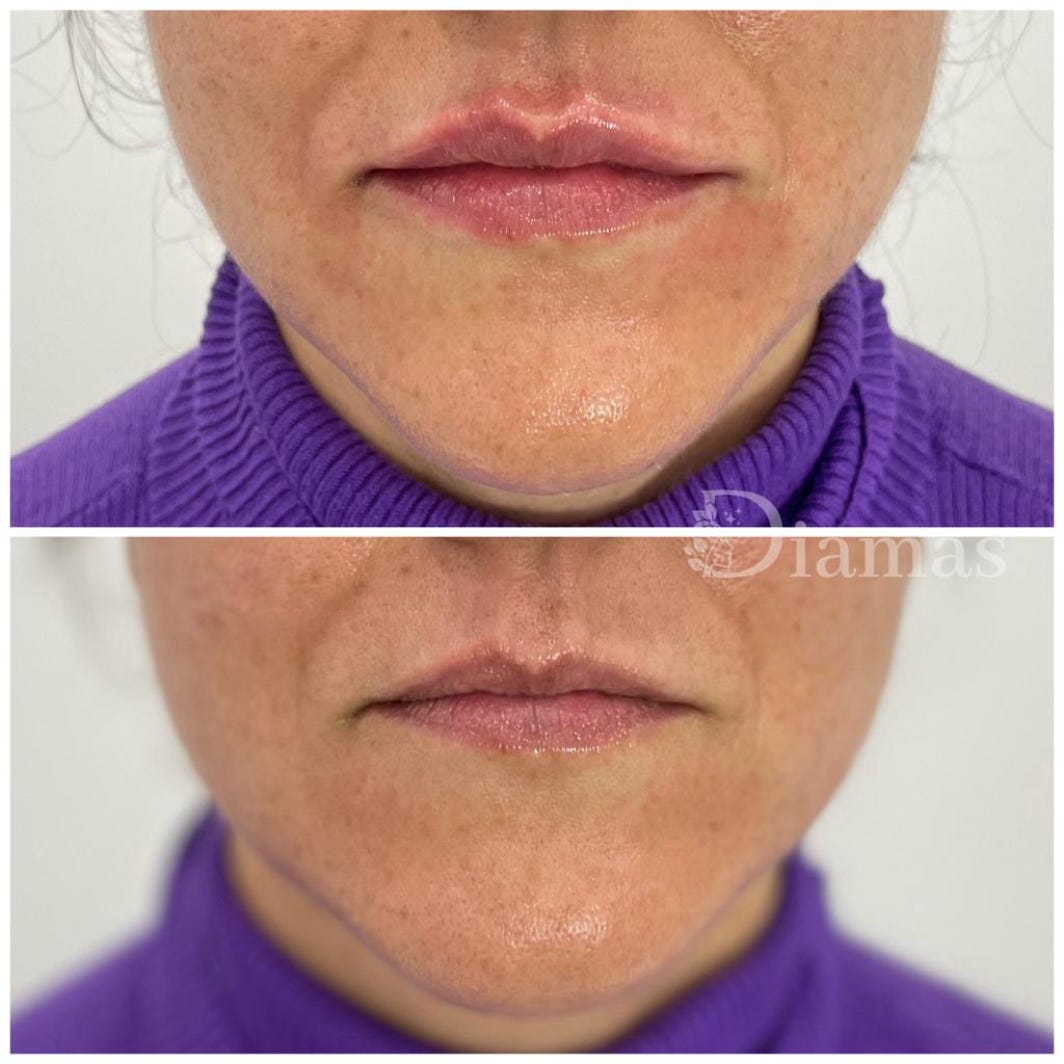 RELLENO DE LABIOS MALAGA, ACIDO HIALURONICO, RELLENOS LABIOS, DOCTORA RELLENO LABIOS