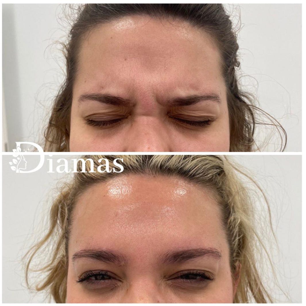 ELIMINACION ARRUGAS DIAMAS MALAGA, BOTOX MALAGA, ELIMINACION DE ARRUGAS MALAGA