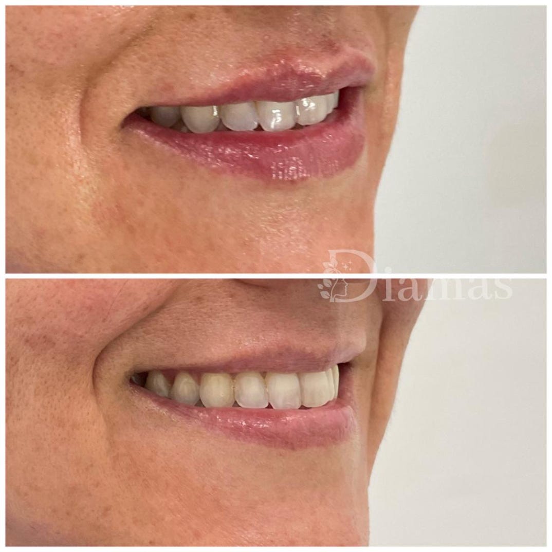 acido hialuronico, relleno de labios Diamas malaga 