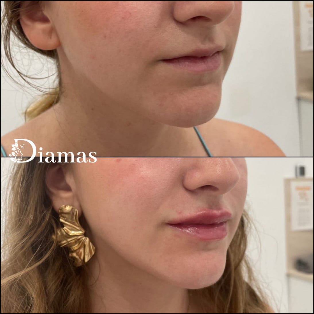 RELLENO DE LABIOS MALAGA, ACIDO HIALURONICO MALAGA, LABIOS, MEDICINA ESTETICA