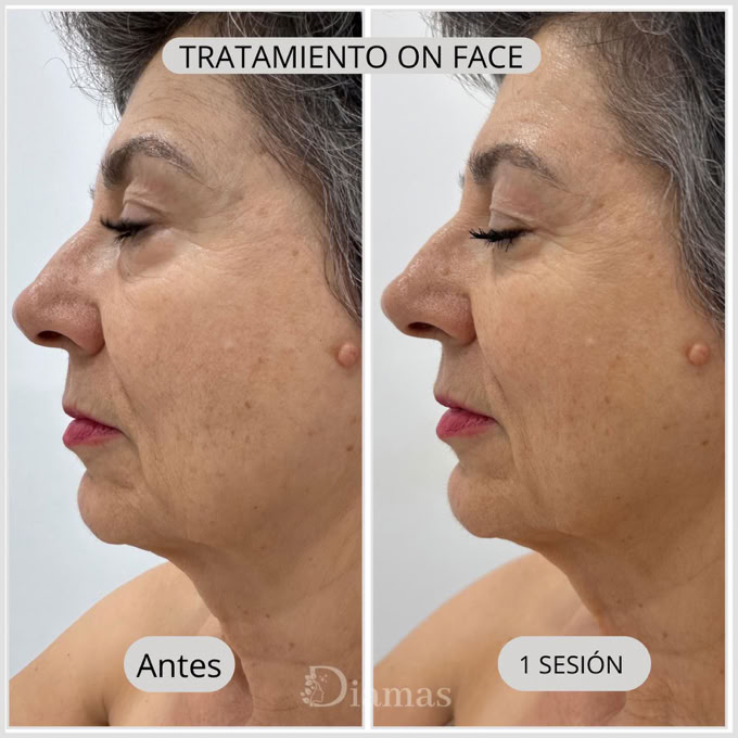 TRATAMIENTO ON FACE, ELIMINACION DE ARRUGAS, TRATAMIENTO REJUVENECIMIENTO, ON FACE